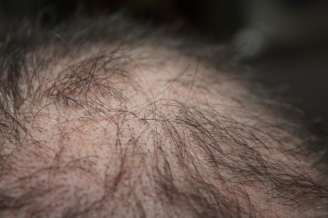 hair g80266fd3c 640 After a hair transplant, the way to acknowledge and deal with an an infection